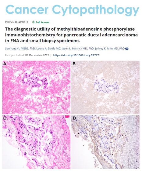 As loss of MTAP expression is not expected in nonneoplastic cells, these findings suggest that MTAP IHC can support a diagnosis of pancreatic ductal adenocarcinoma in small biopsy samples.

acsjournals.onlinelibrary.wiley.com/doi/10.1002/cn…

<a href="/SanhongY/">Sanhong Yu, MD, PhD</a>
<a href="/JLHornick/">Jason L. Hornick, M.D., Ph.D.</a> 
CC: <a href="/DianaEstherossi/">Esther Diana Rossi</a> 
#CytoPath
#IHCPath