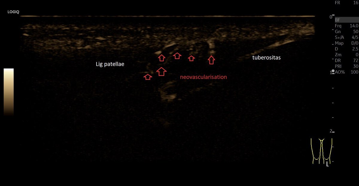 SportklinikBern's tweet photo. #ultrasoundguidedinjection with #arthrexprp for #tendinoptathy of the distal ligamentum patellae - #mskus #pocus #pocushub #GElogiqE10r3 https://t.co/7quzmaw1no
