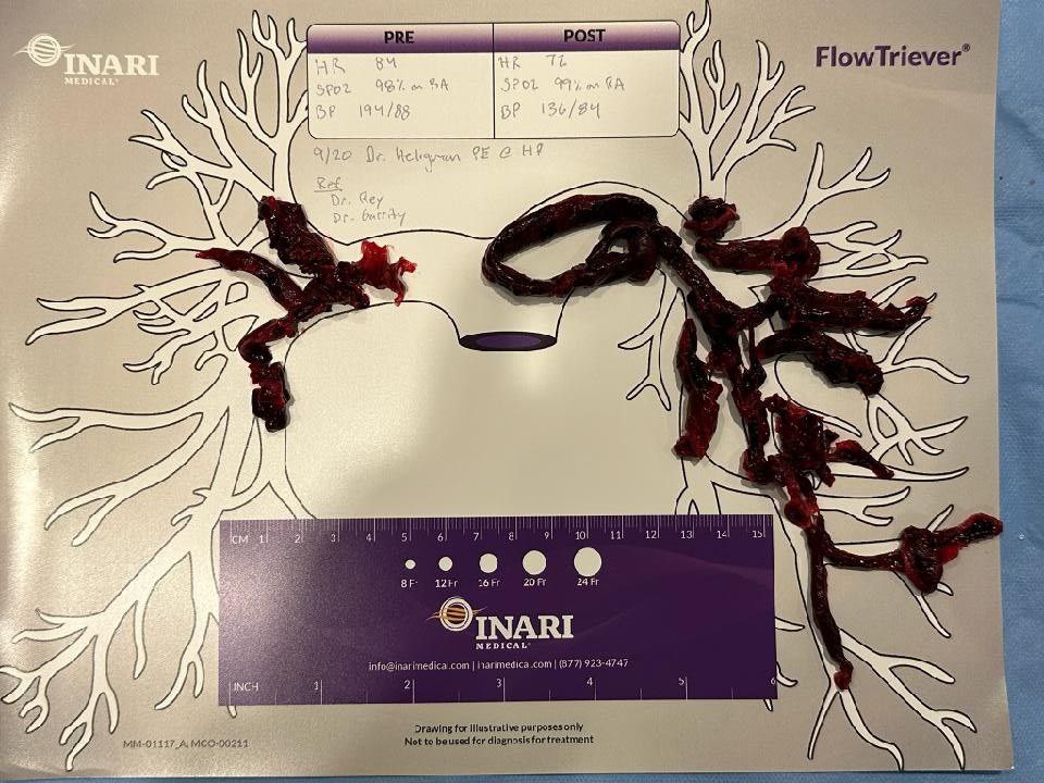 Fully Vaccinated man arrives to the hospital to find that his lungs are filled with blood clots. 

This is NOT normal.