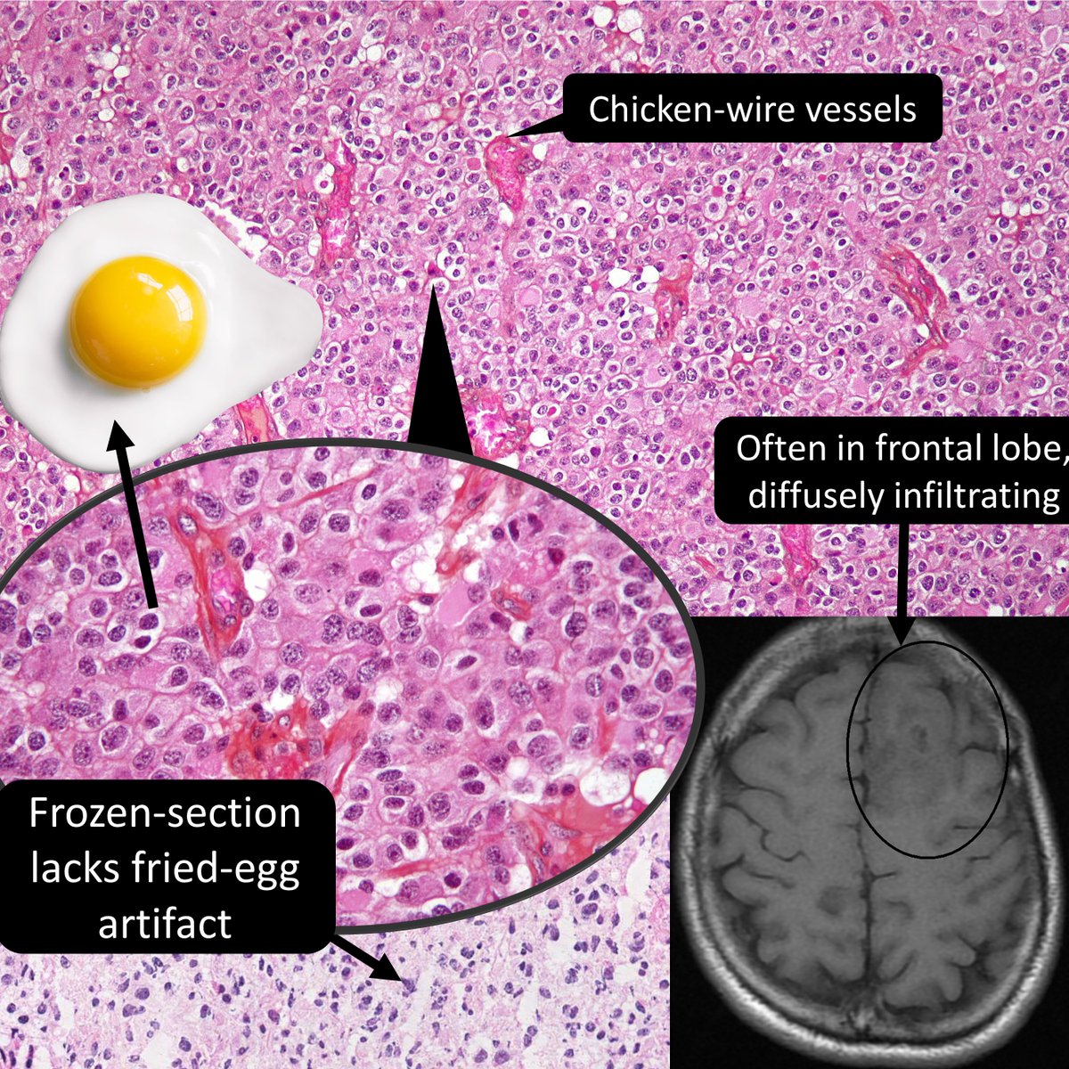 This🍳 glioma is defined by:
A) IDH mutation
B) 1p19q codeletion
C) All of the above
#neuropath #molpath #pathresidents #pathtwitter