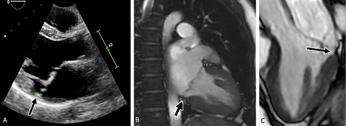 NEW PUBLICATION 📜Mitral Annular Disjunction: Review of an Increasingly Recognized Mitral Valve Entity 🔹A review of the history, pathophysiology, controversy, prevalence, clinical implications, and imaging considerations of MAD ⛓️doi.org/10.1148/ryct.2…