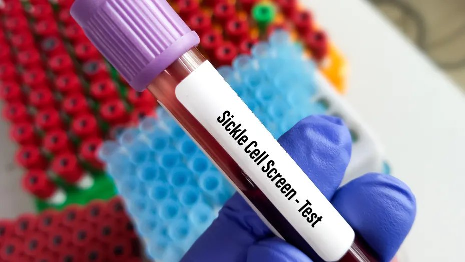 StockMKTNewz's tweet photo. THE 🇺🇸 JUST APPROVED THE FIRST GENE EDITING TREATMENT

The U.S. Food and Drug Administration has approved the country’s first gene-editing treatment, Casgevy, for use in patients with sickle cell disease.

Casgevy uses CRISPR $CRSP technology to treat sickle cell disease, a blood disorder that affects about 100,000 Americans

(Source CNBC)