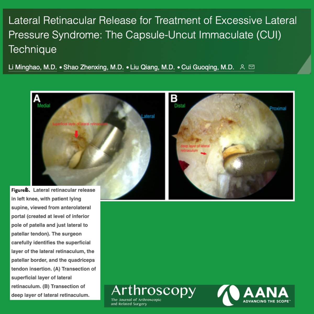 Lateral Retinacular Release for Treatment of Excessive Lateral Pressure Syndrome: The Capsule-Uncut Immaculate (CUI) Technique ow.ly/OZ9c50QeRMO