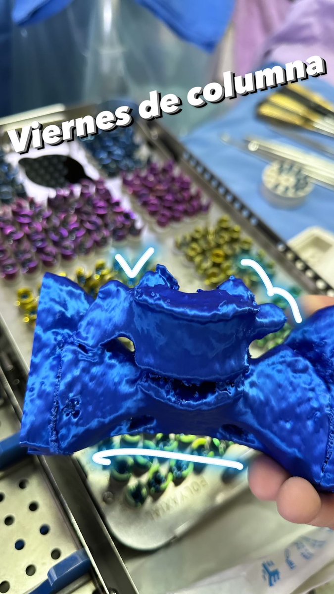 OrtoDrJuarez's tweet photo. Castellvi IIa #columna #3dcot #3dprint https://t.co/DH8o3CAT7q