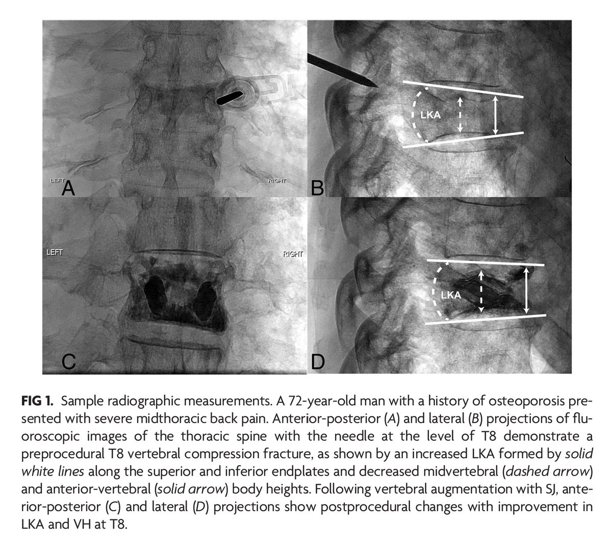 "Clinical Outcomes and Safety Comparison of Vertebroplasty, Balloon Kyphoplasty, and Vertebral Implant for Treatment of Vertebral Compression Fractures" #CompressionFractures #OpenAccess <a href="/The_ASSR/">American Society of Spine Radiology (ASSR)</a> <a href="/taibo_li/">Taibo</a> | bit.ly/47O25WA