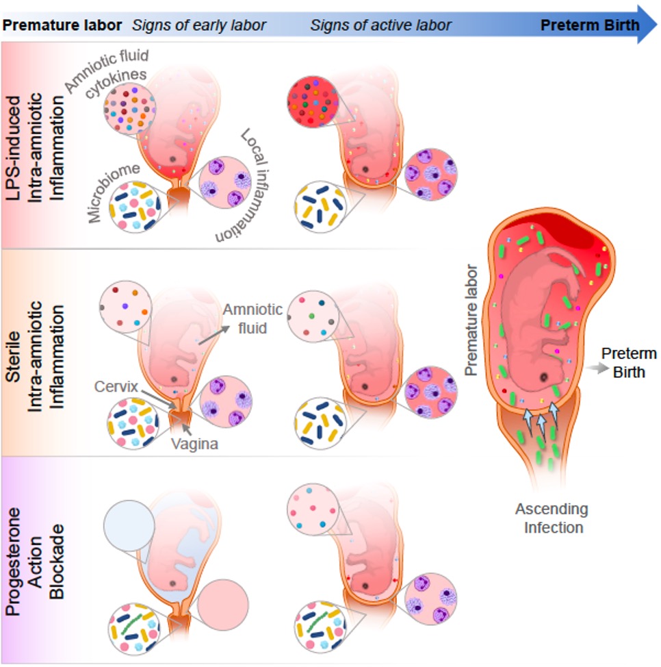 Our new study in @iScience_CP explores complex host-microbiome interactions in preterm labor showing relationships between intra-amniotic inflammation, the vaginal microbiome, and cervical shortening bit.ly/4apErBB #NICHDnews #NGLLab #CRepHS @WUSTL@WUSTLmed @WashU_OBGYN