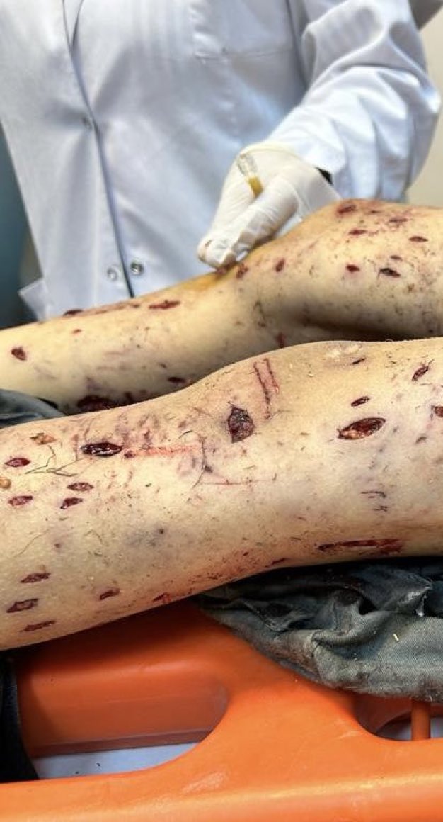 Ankara'da sokak köpeklerinin saldırısına uğrayan çocuğun fotoğrafı bu. Sokakta bu kadar köpek olmaz kim ne derse desin. Bu iş artık hayvanseverlik değil manyaklık haline geldi. Sürüler halinde köpekler nerede var gösterin bir ülke de tamam varmış diyelim. Bu ne yahu!