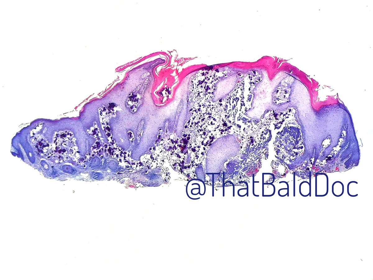 ThatBaldDoc's tweet photo. 👀 A subepidermal calcified nodule (idiopathic calcinosis cutis), from the upper eyelid of a 14-year-old male.

#DermPath https://t.co/TT7y84cV00