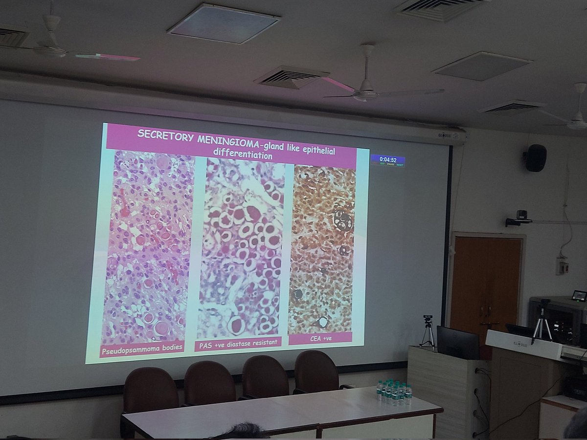 ViralBhanvadia's tweet image. #APCON2023 @Apcon2023 #CNSpath #neuropath meningioma- WHO CNS5