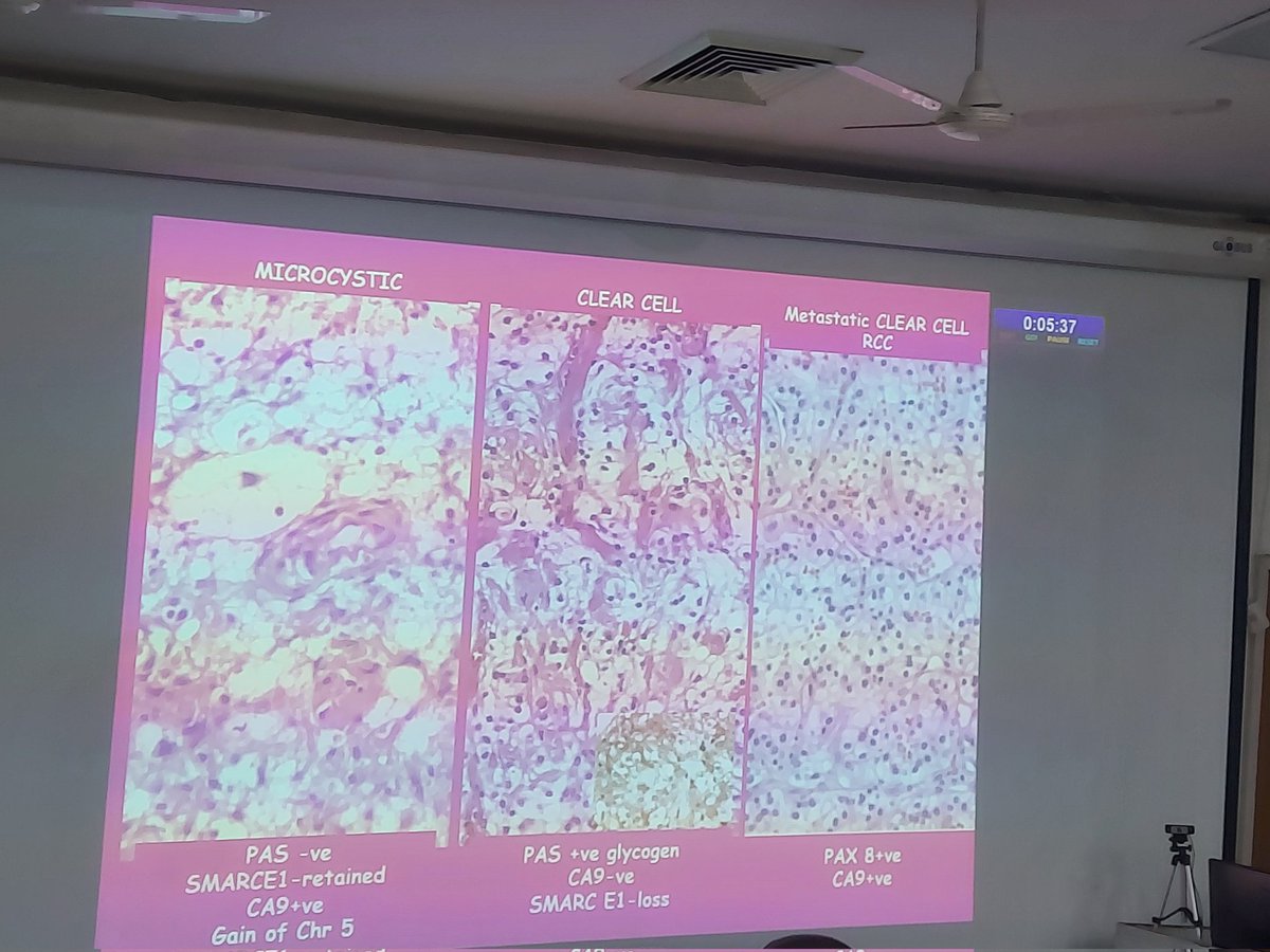 ViralBhanvadia's tweet image. #APCON2023 @Apcon2023 #CNSpath #neuropath meningioma- WHO CNS5