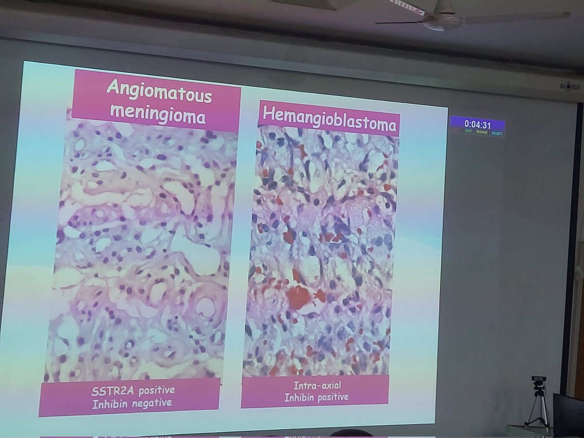 ViralBhanvadia's tweet image. #APCON2023 @Apcon2023 #CNSpath #neuropath meningioma- WHO CNS5