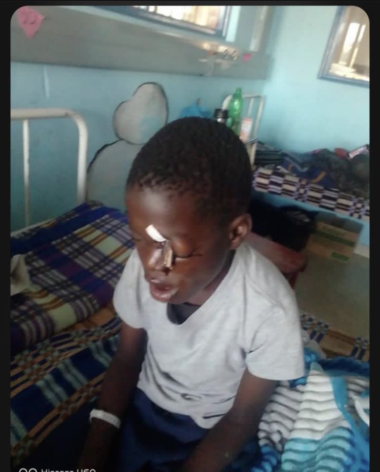 zimstar_news's tweet photo. The family of a nine-year old boy Future Tshuma are seeking help in raising funds for a medical treatment to remove a piece of wood stuck in his eye and skull.
Future fell when he was on his way home from school and suffered this injury.
#help #Zimbabwe #Medical #injur @MoHCCZim https://t.co/MsVBUfhtu6