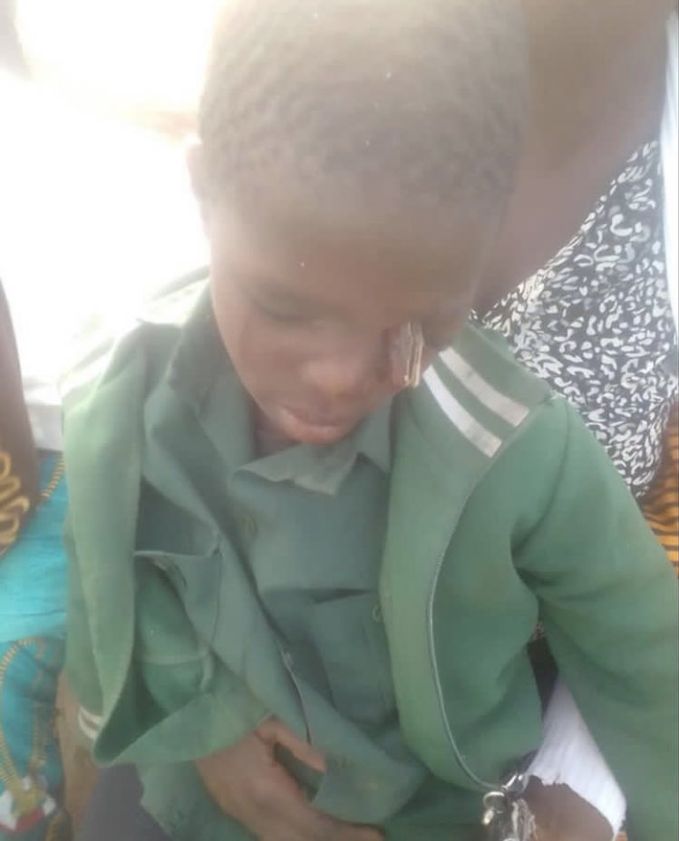 zimstar_news's tweet photo. The family of a nine-year old boy Future Tshuma are seeking help in raising funds for a medical treatment to remove a piece of wood stuck in his eye and skull.
Future fell when he was on his way home from school and suffered this injury.
#help #Zimbabwe #Medical #injur @MoHCCZim https://t.co/MsVBUfhtu6
