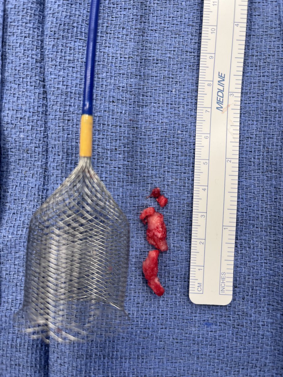 Another organized thrombus removed with ŌNŌ from the right atrium of a patient in Houston! ŌNŌ delivered yet again, making this procedure safe and effective ! Thank you <a href="/ONOCORvascular/">ŌNŌCOR</a> !

<a href="/ONOCORvascular/">ŌNŌCOR</a>
<a href="/mjgillespie1/">Matthew Gillespie</a>
#ŌNŌ_helps