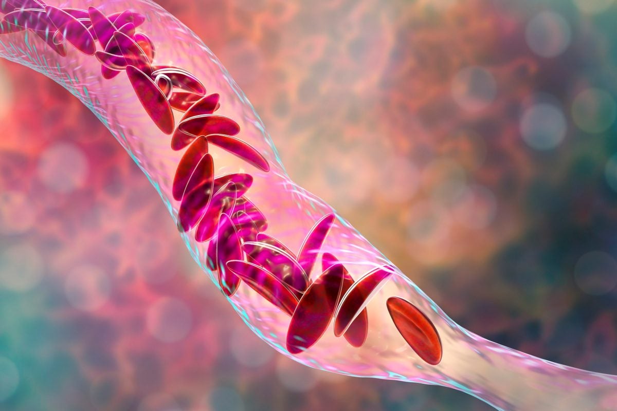 FDA Approves First Gene Therapies🔥 to Treat Patients with Sickle Cell Disease🧬🧫 👫 >12 yrs 💥 Casgevy #CRISPR/Cas9 based 💥 Lyfgenia #stemcell modification based fda.gov/news-events/pr… #GeneTherapy #SickleCell #molecularbiology #GeneEditing #biochemistry