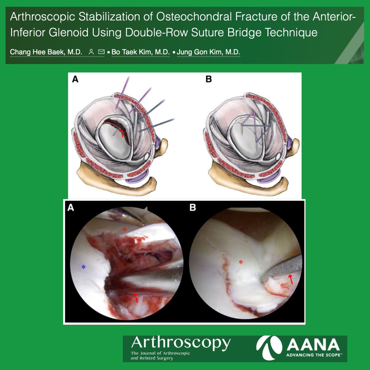 Arthroscopic Stabilization of Osteochondral Fracture of the Anterior-Inferior Glenoid Using Double-Row Suture Bridge Technique ow.ly/zE3K50QeRO3