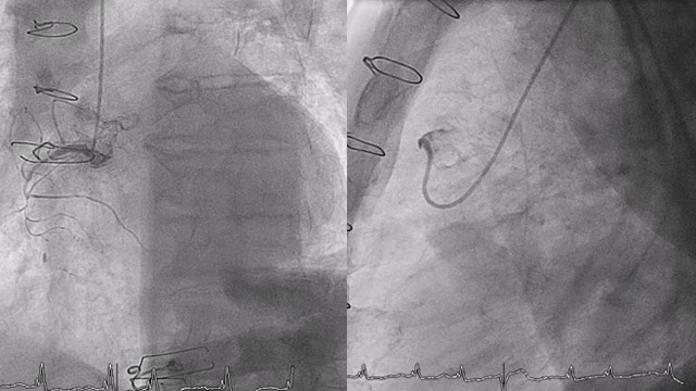 How would you treat this patient? 

In this new #Euro4C case, characterized by multimorbidity, the team evaluated a patient with left main, multi-vessel disease, RCA CTO, severely reduced EF, and constrictive surgical valve. Traditional pathways for vascular access were limited