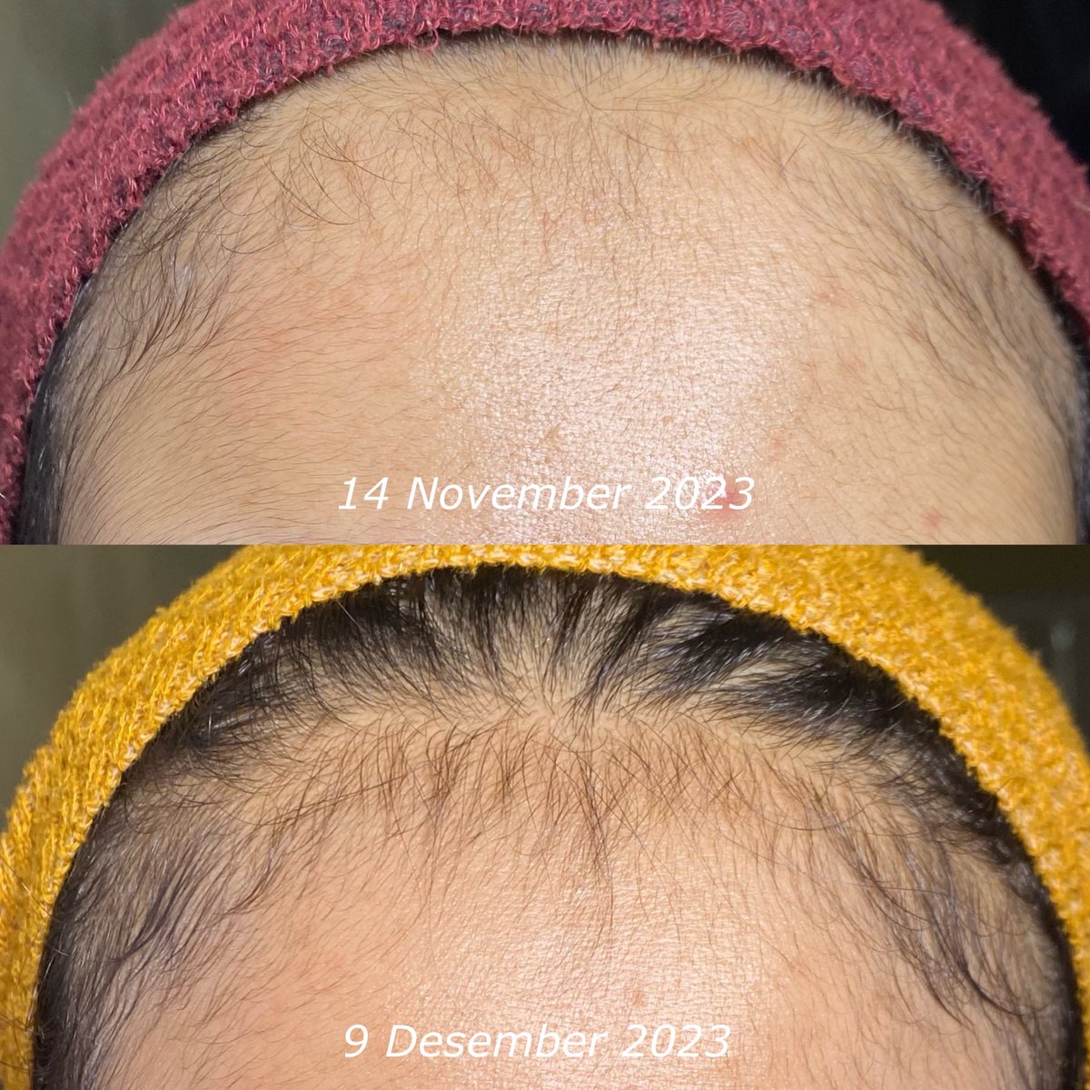 wnisekai's tweet photo. BJIR, FOMO NI EMG BAHAYA! 

GARA-GARA RACUNNYA TASYA FARASYA GAK NYANGKA BABY HAIR KU BISA TUMBUH SEBANYAK INI?!? 😭 #HaiRescue #racuninhaircare https://t.co/iQSZD8vyMK