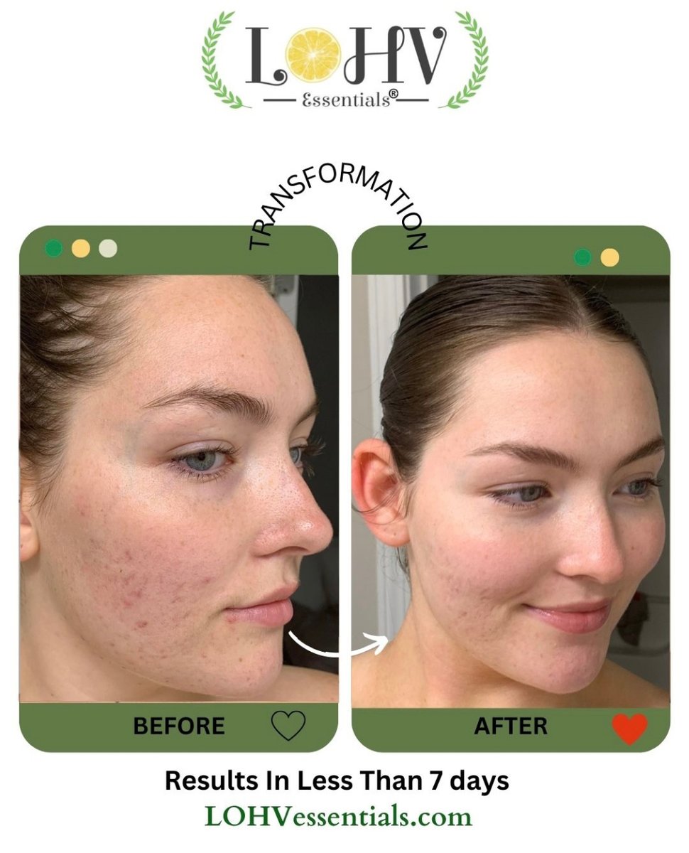 Lohvessentials's tweet photo. A Jelly Turmeric + Retinol + hyaluronic Acid + 100% Vegan Face Mask that works. Our Jelly Face Mask helps with tightening your skin naturally, clearing skin impurities, formulated fro all skin types.

Receive yours today on https://t.co/KkiKoOcdPq https://t.co/UCLqZEcR48