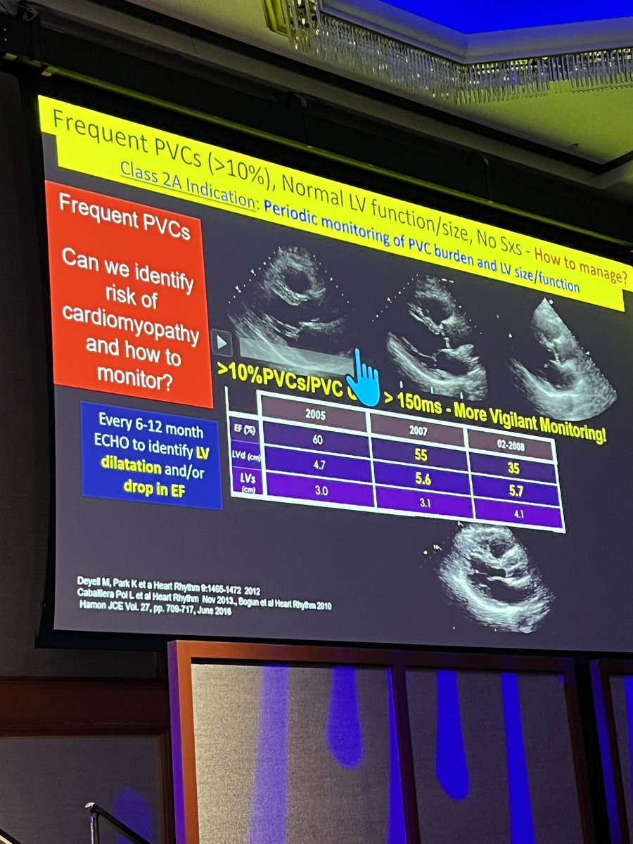 Dr Marchlinski discussion of PVCs- even if asymptomatic, important to regularly assess LV function. ESC guidelines suggest consideration of PVC ablation when high frequency of PVCs and normal LVEF. #NYCVS23