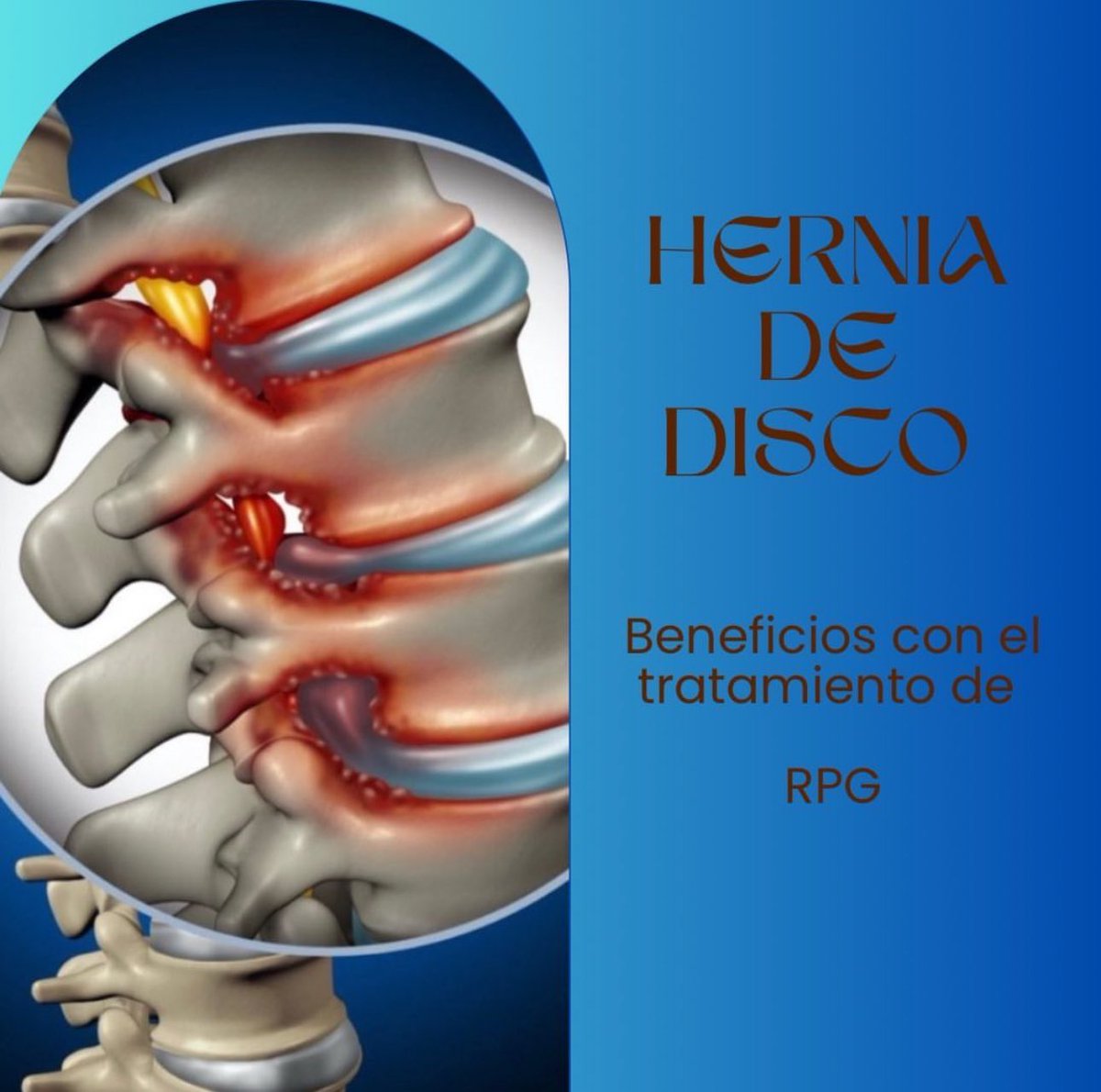 Kinesio_Em's tweet photo. La RPG®️( reeducación postural global), logra una convivencia pacífica entre el fragmento herniado y el resto de las estructuras involucradas, disminuyendo así la rigidez de los tejidos, logrando una mayor movilidad, impidiendo el aumento y la perpetuidad del dolor. https://t.co/uJB5svyKAF