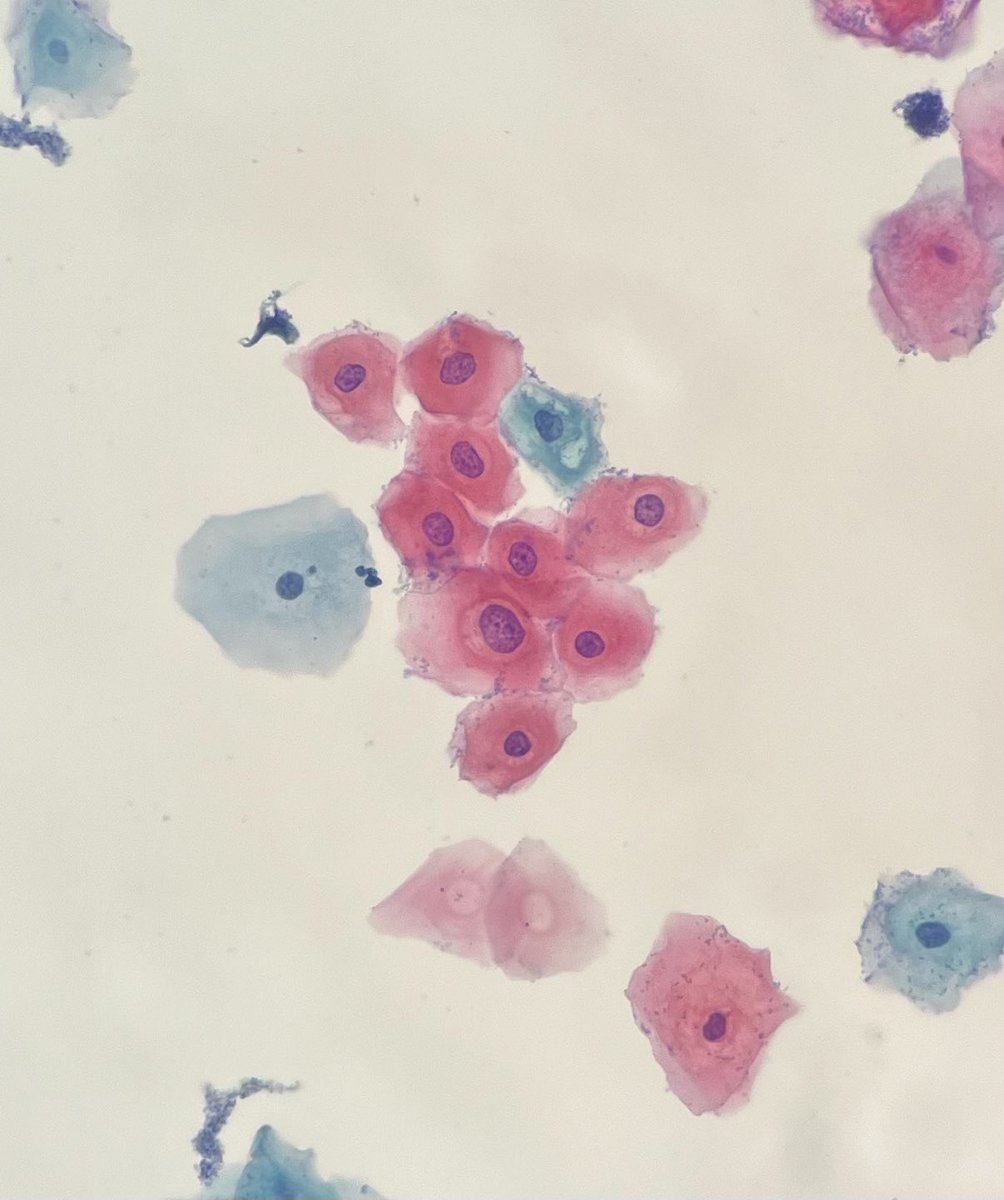 MeredithKHerman's tweet photo. PAP quiz! π‘
Test your cytology knowledge through these classic cases π¬
#PathTwitter #PathX #cytology #cytopath #PathPopQuiz https://t.co/XwvssTZnrv