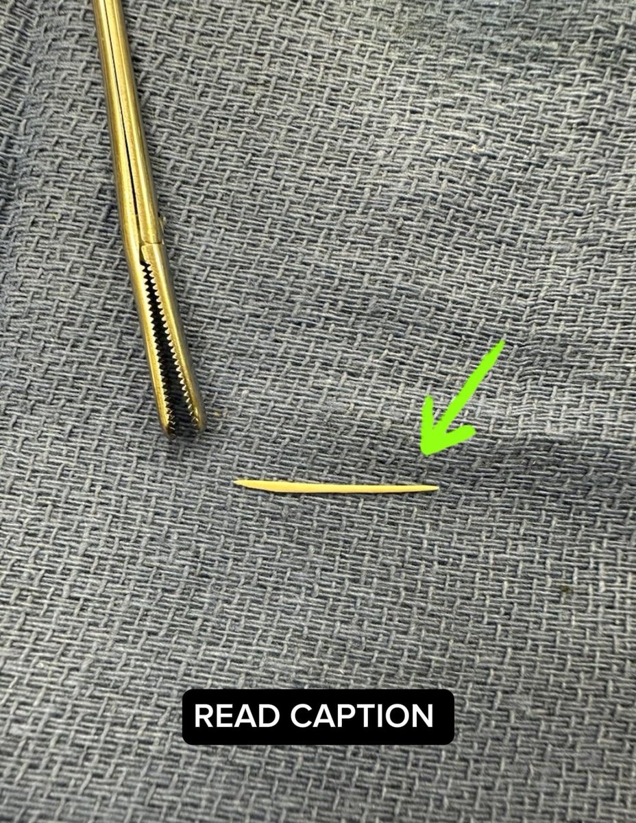 ENTInstitute's tweet photo. 🌟 Successful Foreign Body Removal at ENT Institute 🌟

Recently, Dr. Carothers at the ENT Institute demonstrated exceptional skill and precision in removing a foreign body - a piece of goat bone from a delicious curry goat meal - from a patient's throat. This intricate procedure highlights the expertise and care our specialists offer.

👉 Do you have throat discomfort or suspect something's amiss? Don't wait! The ENT Institute is here for all your throat health needs. Our team, led by the renowned Dr. Carothers, is equipped with state-of-the-art technology and a compassionate approach to ensure your throat health is in the best hands.

📞 Call us today at 770-740-1860 for a consultation and experience the best in ENT care!

#ENTHealth #ThroatCare #DrCarothers #ForeignBodyRemoval #ExpertCare