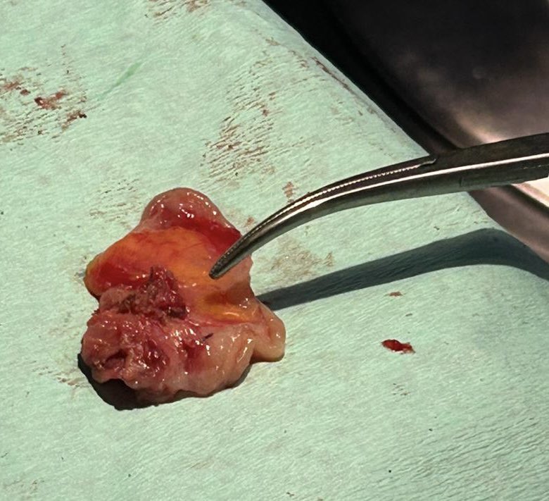 ENDOMETRIOSIS: DISCOID RESECTION OF RECTOSIGMOID NODULES #DCRJournal