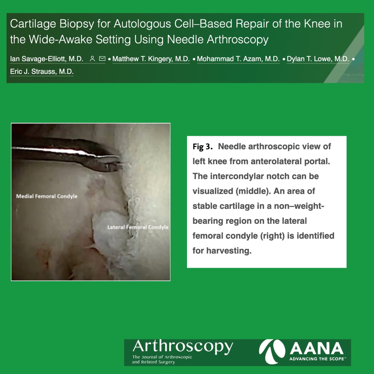 Cartilage Biopsy for Autologous Cell–Based Repair of the Knee in the Wide-Awake Setting Using Needle Arthroscopy @ericstraussmd ow.ly/owTb50QeROu