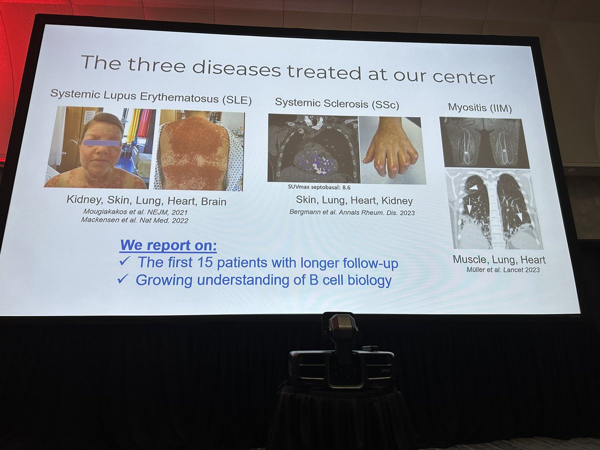 hemedoc's tweet photo. #ASH23 #celltx Mueller: SLE, SSc, and autoimmune myositis eligible for this study with an FMC63/41BB construct. Little CRS (no gr3+ and only 1/15 gr2). 1/15 gr1 ICANS, none higher. https://t.co/yhMIi9qP51