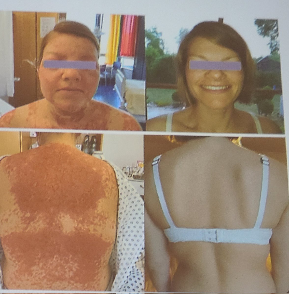 BrianOrelli's tweet image. Woman on left and right are the same person. SLE before and after CD19 CAR-T treatment. 🤯

Due to wax and wane in SLE, it has been hard to prove drugs work. Much easier when you cure patients! No relapses for 8 patients 4-29 months followup. #ash23