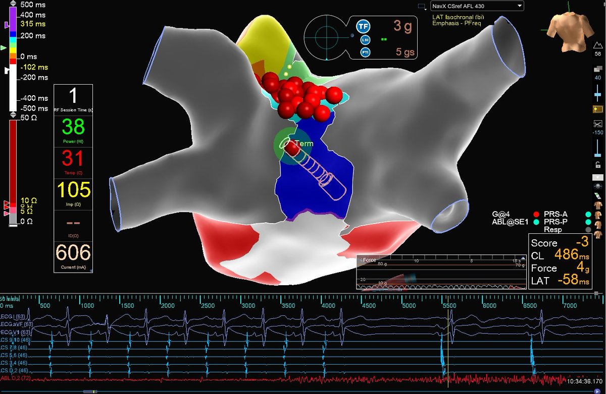 Hapa_EP's tweet photo. A new roof line, although it slowed the flutter, failed to terminate it. A single burn ❤️‍🔥 down lower in the mid posterior wall finally succeeded in terminating tachycardia. #AblateAF https://t.co/uYveEV6TgF