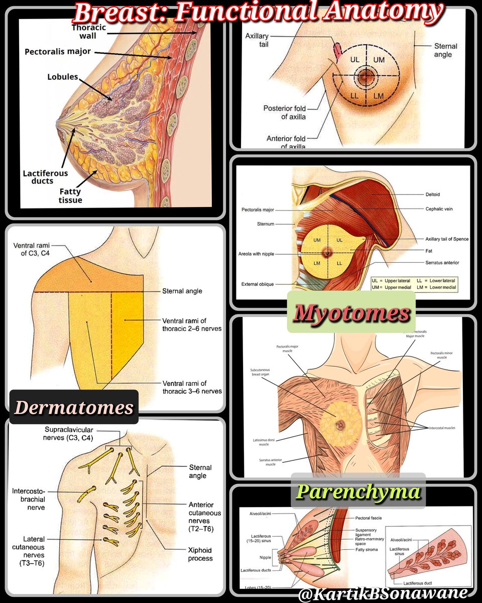 KartikBSonawane's tweet photo. “RA in Breast Sx: Knowing Targets as per Sx is the Key.”

#RAinBreastSx
#BreastSx
#PainManagementinBreastSx

My 10 Points:

A. BREAST ANATOMY

1. Modified Sweat gland lying over Pec.Fascia (covering PMM) & separated by Retromammary space. 
A small extension of Upper lateral quadrant (Axillary tail of Spence) passes through an opening in Deep fascia (Foramen of Langer).
 
2. Breast structure:
Skin: Nipple (4th ICS) is pierced by 15-20 lactiferous ducts, having few modified Sweat & Sebaceous glands Rich Ns supply/FNEs. Areola (pigmented skin) Rich in modified sebaceous glands. Enlarged glands during pregnancy/lactation-Raised tubercles of Montgomery. Lactiferous sinuses (where milk is stored) lie below  areola.

Parenchyma: Consists of tubulo-alveolar glands that secrete milk. Each gland consists of 15-20 lobes, cluster of alveoli drained by a lactiferrrous duct.

Stroma: Supporting framework -Fibrous+ Fatty. Fibrous stroma forms septa (suspensory ligaments of Cooper), anchoring Skin &  gland to the Pec.Fascia. 
Fatty stroma forms main bulk distributed all over the breast.

3. Breast innervation: 
Cut. supply (Dermatomes) - Cervical plexus(SCN), ICBN(T2), ICNs(T3-T6).

Myofascial supply (Myotomes) - Brachial plexus[MPN (C8-T1), LPN (C5-C7),TDN (C6-C8), LTN (C5-C7)]. 

Milk Secretion- Controlled by Prolactin.

B. BREAST-CONSERVING SURGERIES (BCS)

4. Lumpectomy, Wide excision, Quadrantectomy, & partial mastectomy. High recurrence rate.
Target Innervation: Involved Dermatome.
RA technique:  LIA.
 
C. NON BCS

5. Simple mastectomy:
Incision: Superiorly till clavicle, Laterally till PMM Lateral border, Medially to sternum, & Inferiorly till inframammary fold.
Excision: Entire subcut breast tissue  + overlying skin.
Intact: PMM & its Fascia not disrupted. LN & Muscle. 

Target Innervations: ICBN, ACNs, LCNs, & SCN.  
RA techniques: EA/PVB + Superficial cervical plexus/Selective SCN Block or LIA.

6. Radical Mastectomy:
Most extensive Sx.
Incision: Superiorly till clavicle, Laterally till anterior margin of LDM, Medially to sternum, and inferiorly till Costal margin.
Excision: Breast tissues, axillary LN, & Pectoral muscles. 
Complications: Bad scarring, deformity, reduced shoulder movement, Chronic pain.

Target Innervations: ICBN, ACNs, LCNs, SCN, LPN & MPN. 
RA techniques: EA/PVB + Sup CPB/Selective SCNB or LIA, PEC 2, or SAP + PEC 1.
 
7. Modified Radical Mastectomy:
Incision: Superiorly till clavicle, Laterally till anterior margin of LDM, Medially to sternum, & Inferiorly till Costal margin.
Excision: Breast tissues & axillary LN.
Intact: Pectoral Ms. 

Target Innervations: ICBN, ACNs, LCNs, SCN, LPN & MPN.
RA techniques: EA/PVB + Sup. CPB/Selective SCNB or LIA, PEC 2, or SAP + PEC 1.
 
D. COSMETIC BREAST Sx

8. Breast Augmentation Sx:
Incisions: Peri-areolar, Inframammary, Trans-axillary, or Trans-umbilical. 
Surgery: Involves pocket formation disrupting pectoral Ms.

Reduction Mammoplasty. Breast-Lift Sx (Mastopexy). 

Target innervations & RA techniques: As per approaches.

9. Reconstructive Mammoplasty: 
LD Myocutaneous flap, Transversus Rectus Abdominis Myocutaneous (TRAM) flap. 
Surgery: Implants are placed between PMM-PMnM & laterally elevating SAM. 

Target innervations: Pectoral Ns. (MPN & LPN), LCBs of ICNs, LTN, and TDN (if LD flap is used). 
RA technique: EA/PVB + Sup.CPB/Selective SCNB or LIA, PEC 2, SAP + PEC 1, RSB/TAP (for TRAM).
 
E. RA OPTIONS

10. For Anesthesia:Thoracic EA (Bilateral Sx), Thoracic PVB (Unilateral Sx) +/- LIA/SCNB.

For Analgesia:LIA (for BCS), PEC 2(Non-BCS), SAP+PEC 1 or PEC  (Non-BCS with axillary clearance).

Surgical Perspective: 
Large LA volume can affect surgical dissection & electrical cautery function. Sometimes,  use neurostimulation to identify & preserve LTN - Ineffective with LA solution.

Anesthesia Perspective: Optimal analgesia, reduced GA drug req./opioid consumption,Clear surgical field,reduced Stress response (Symp. block),& Avoids chronic pain.