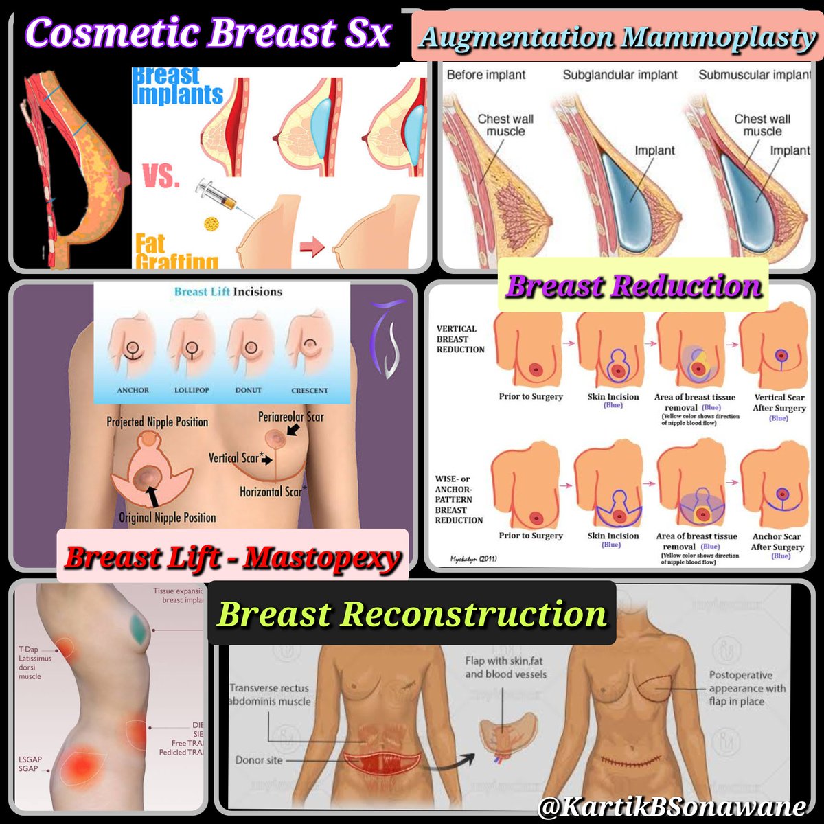 KartikBSonawane's tweet photo. “RA in Breast Sx: Knowing Targets as per Sx is the Key.”

#RAinBreastSx
#BreastSx
#PainManagementinBreastSx

My 10 Points:

A. BREAST ANATOMY

1. Modified Sweat gland lying over Pec.Fascia (covering PMM) & separated by Retromammary space. 
A small extension of Upper lateral quadrant (Axillary tail of Spence) passes through an opening in Deep fascia (Foramen of Langer).
 
2. Breast structure:
Skin: Nipple (4th ICS) is pierced by 15-20 lactiferous ducts, having few modified Sweat & Sebaceous glands Rich Ns supply/FNEs. Areola (pigmented skin) Rich in modified sebaceous glands. Enlarged glands during pregnancy/lactation-Raised tubercles of Montgomery. Lactiferous sinuses (where milk is stored) lie below  areola.

Parenchyma: Consists of tubulo-alveolar glands that secrete milk. Each gland consists of 15-20 lobes, cluster of alveoli drained by a lactiferrrous duct.

Stroma: Supporting framework -Fibrous+ Fatty. Fibrous stroma forms septa (suspensory ligaments of Cooper), anchoring Skin &  gland to the Pec.Fascia. 
Fatty stroma forms main bulk distributed all over the breast.

3. Breast innervation: 
Cut. supply (Dermatomes) - Cervical plexus(SCN), ICBN(T2), ICNs(T3-T6).

Myofascial supply (Myotomes) - Brachial plexus[MPN (C8-T1), LPN (C5-C7),TDN (C6-C8), LTN (C5-C7)]. 

Milk Secretion- Controlled by Prolactin.

B. BREAST-CONSERVING SURGERIES (BCS)

4. Lumpectomy, Wide excision, Quadrantectomy, & partial mastectomy. High recurrence rate.
Target Innervation: Involved Dermatome.
RA technique:  LIA.
 
C. NON BCS

5. Simple mastectomy:
Incision: Superiorly till clavicle, Laterally till PMM Lateral border, Medially to sternum, & Inferiorly till inframammary fold.
Excision: Entire subcut breast tissue  + overlying skin.
Intact: PMM & its Fascia not disrupted. LN & Muscle. 

Target Innervations: ICBN, ACNs, LCNs, & SCN.  
RA techniques: EA/PVB + Superficial cervical plexus/Selective SCN Block or LIA.

6. Radical Mastectomy:
Most extensive Sx.
Incision: Superiorly till clavicle, Laterally till anterior margin of LDM, Medially to sternum, and inferiorly till Costal margin.
Excision: Breast tissues, axillary LN, & Pectoral muscles. 
Complications: Bad scarring, deformity, reduced shoulder movement, Chronic pain.

Target Innervations: ICBN, ACNs, LCNs, SCN, LPN & MPN. 
RA techniques: EA/PVB + Sup CPB/Selective SCNB or LIA, PEC 2, or SAP + PEC 1.
 
7. Modified Radical Mastectomy:
Incision: Superiorly till clavicle, Laterally till anterior margin of LDM, Medially to sternum, & Inferiorly till Costal margin.
Excision: Breast tissues & axillary LN.
Intact: Pectoral Ms. 

Target Innervations: ICBN, ACNs, LCNs, SCN, LPN & MPN.
RA techniques: EA/PVB + Sup. CPB/Selective SCNB or LIA, PEC 2, or SAP + PEC 1.
 
D. COSMETIC BREAST Sx

8. Breast Augmentation Sx:
Incisions: Peri-areolar, Inframammary, Trans-axillary, or Trans-umbilical. 
Surgery: Involves pocket formation disrupting pectoral Ms.

Reduction Mammoplasty. Breast-Lift Sx (Mastopexy). 

Target innervations & RA techniques: As per approaches.

9. Reconstructive Mammoplasty: 
LD Myocutaneous flap, Transversus Rectus Abdominis Myocutaneous (TRAM) flap. 
Surgery: Implants are placed between PMM-PMnM & laterally elevating SAM. 

Target innervations: Pectoral Ns. (MPN & LPN), LCBs of ICNs, LTN, and TDN (if LD flap is used). 
RA technique: EA/PVB + Sup.CPB/Selective SCNB or LIA, PEC 2, SAP + PEC 1, RSB/TAP (for TRAM).
 
E. RA OPTIONS

10. For Anesthesia:Thoracic EA (Bilateral Sx), Thoracic PVB (Unilateral Sx) +/- LIA/SCNB.

For Analgesia:LIA (for BCS), PEC 2(Non-BCS), SAP+PEC 1 or PEC  (Non-BCS with axillary clearance).

Surgical Perspective: 
Large LA volume can affect surgical dissection & electrical cautery function. Sometimes,  use neurostimulation to identify & preserve LTN - Ineffective with LA solution.

Anesthesia Perspective: Optimal analgesia, reduced GA drug req./opioid consumption,Clear surgical field,reduced Stress response (Symp. block),& Avoids chronic pain.