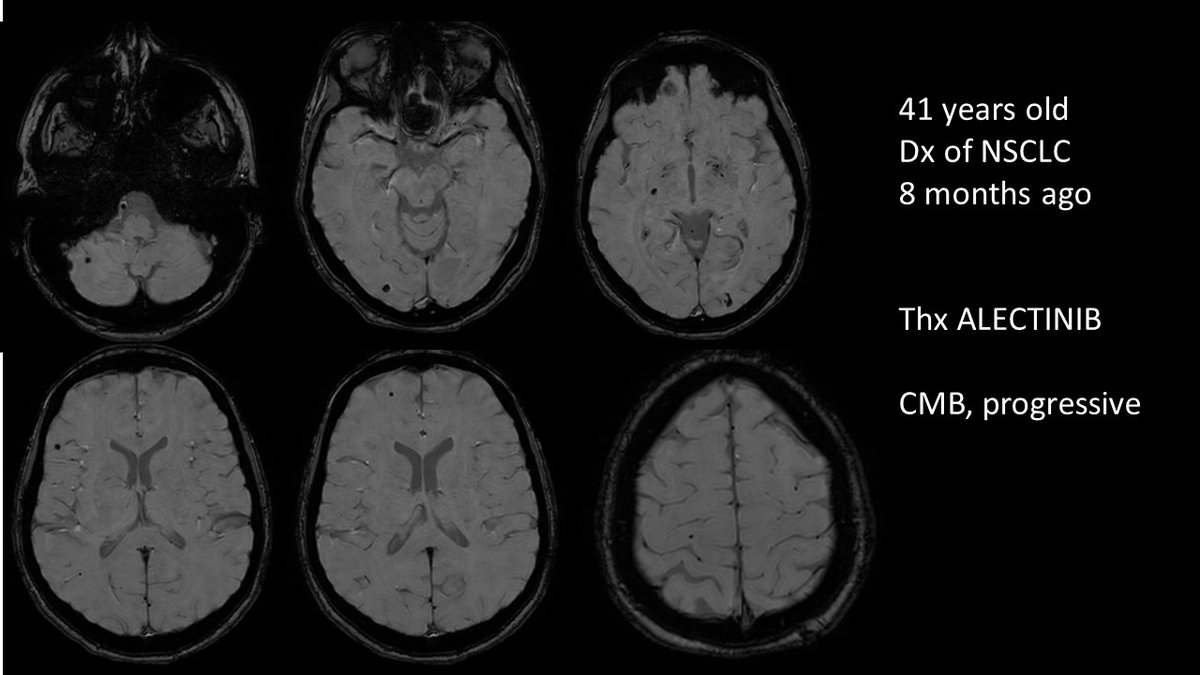 Saw a patient (41y) with NSCLC who responds well to Alectinib but develops CMB (see image), growing in number. Any thoughts? @a_charidimou @CatarinaACF @Gaborpetzold @SchreuderFloris @PrCCordonier @Lau_Puy @microbleeds #AmyloidAngiopathy #CAA