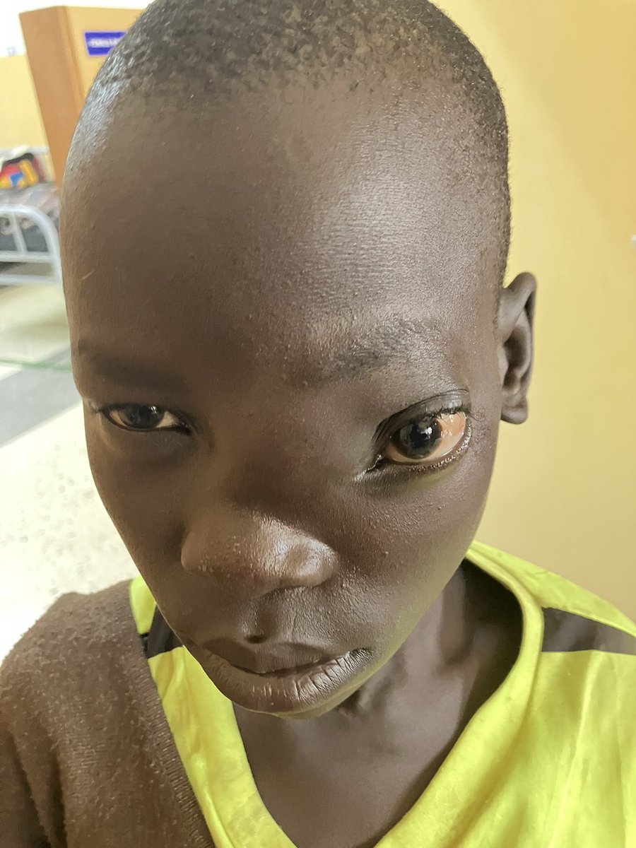 Because of limited expertise, I’m not able to operate on this boy. (Photo taken with consent from the mother). His mother broke down and started crying when I told her she needs to take him to Mulago. Apparently, she had used the only money she had for transporting herself to…