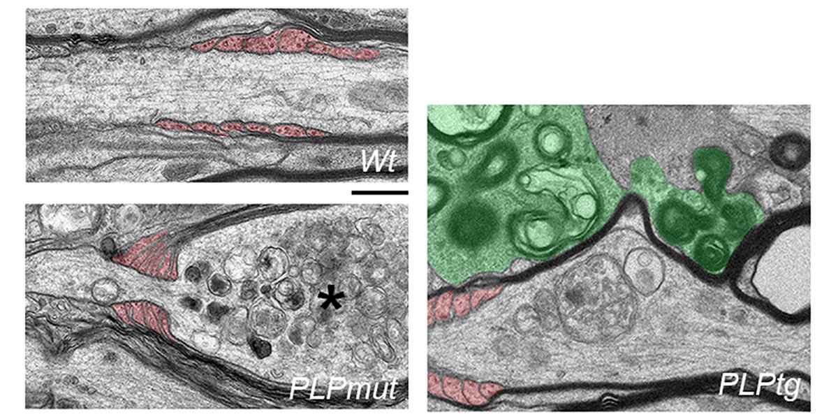 Efficient removal of abnormal #myelin allows survival of nerve fibers targeted by adaptive immune cells, according to a novel study @NatureComms by scientists @Uniklinikum_Wue @GrohJanos @Uni_WUE @TU_Muenchen uni-wuerzburg.de/en/news-and-ev…