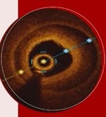 gitalcardiol's tweet photo. L'#OCT fornisce un imaging dettagliato sull'ateroma coronarico. Ma qual è il suo ruolo nella recidiva di #STEMI? Scoprilo sul #GIC online con Clò, Colombi ed Erriquez
https://t.co/kXvhoY2p5F https://t.co/U4vHeqeGWY