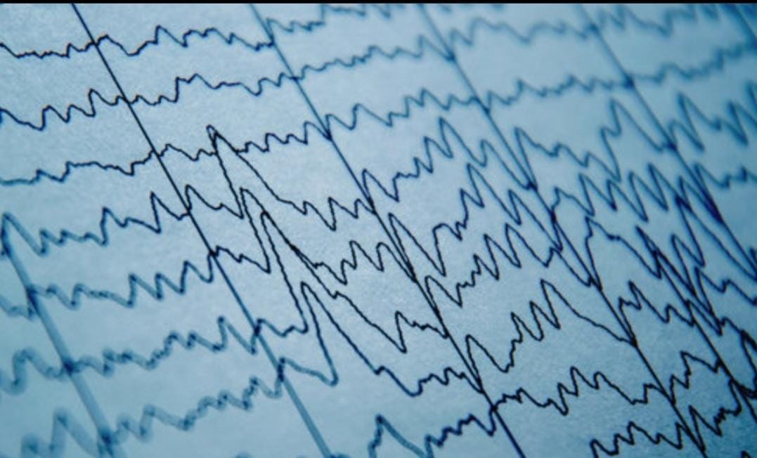snwhealth's tweet image. Original Case #Research Report: Intraoperative EEG biomarkers of abnormal cognition differ between propofol and sevoflurane under generalanesthesia. Neuroanesthesia TIVA

Link -
buff.ly/47Ul7dB

 #generalanesthesia. #Neuroanesthesia #TIVA #snwhealth #snwareresearch
