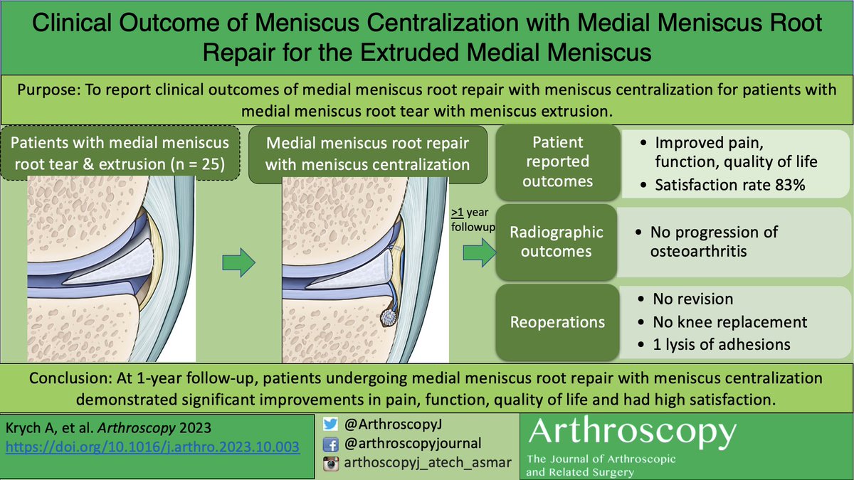 At 1-year follow-up, patients undergoing medial meniscus root repair with meniscus centralization demonstrated significant improvements in pain, function, quality of life and had high satisfaction. ow.ly/3huT50Q2H3e @DrKrych @ColumbiaOrtho #Meniscus #Repair #Root #Sports