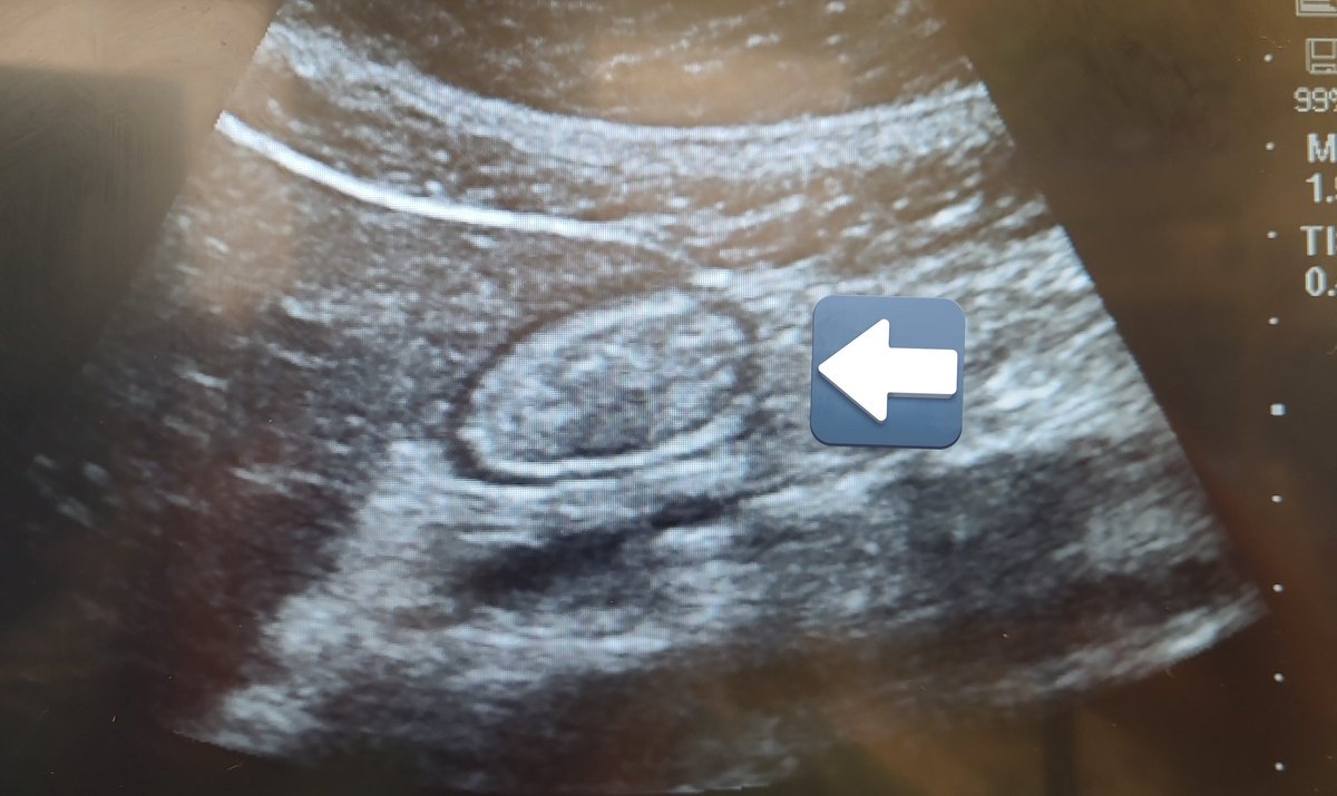 mariapsebastian's tweet photo. After the fantastic #POCUS course led by @rosie_hogg and @elboghdadly I scanned my empty and full stomach👇Although I need more practice,Its a relatively(and surprinsingly) easy skill to learn!Come and learn with them, @BridgetPulos and @Nadia_Hdz_MD to #RAUK24 London 2nd-3rdMay https://t.co/SMaUPbfxl4