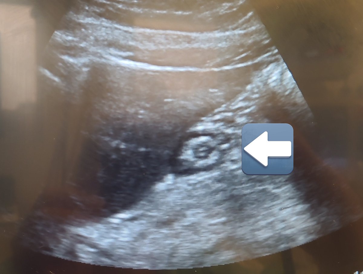 mariapsebastian's tweet photo. After the fantastic #POCUS course led by @rosie_hogg and @elboghdadly I scanned my empty and full stomach👇Although I need more practice,Its a relatively(and surprinsingly) easy skill to learn!Come and learn with them, @BridgetPulos and @Nadia_Hdz_MD to #RAUK24 London 2nd-3rdMay https://t.co/SMaUPbfxl4