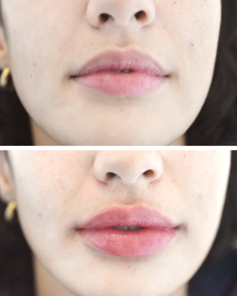 💧👄 Natural, hydrated lip filler results 👄💧
⁠
Hyaluronic acid lip fillers will boost skin hydration in your lips by naturally stimulating the production of your own hyaluronic acid stores.⁠
⁠
#lipfiller #dermalfillers #fillers #lipfillers #filler #beautym#lipfillerlondon