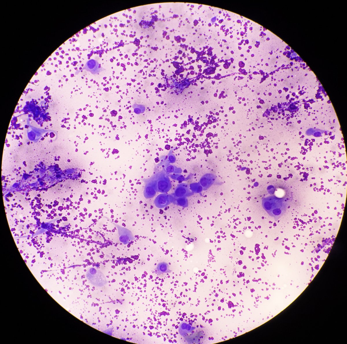 FNA of right thyroid lobe solid/cystic nodule. 35 y/o woman.  Many loosely cohesive groups like seen.  Bethesda group and dDx?  
#PathTwitter #ENTpath #cytopath