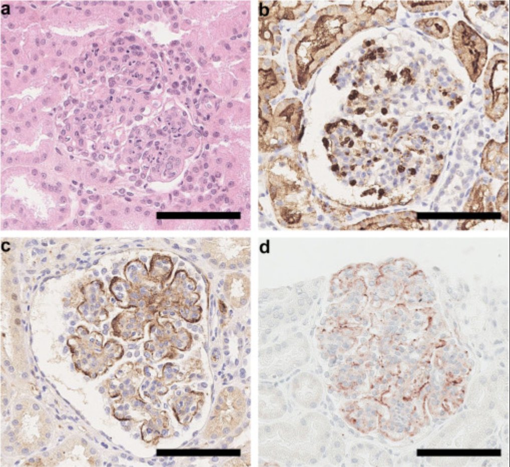 KIReports's tweet image. Diffuse Endocapillary Glomerulonephritis in a Child With #IL-17RA Deficiency Emphasizes the Pivotal Role of the #Complement Cascade and Anaphylatoxins

doi.org/10.1016/j.ekir…

#KIRNephrologyRounds
