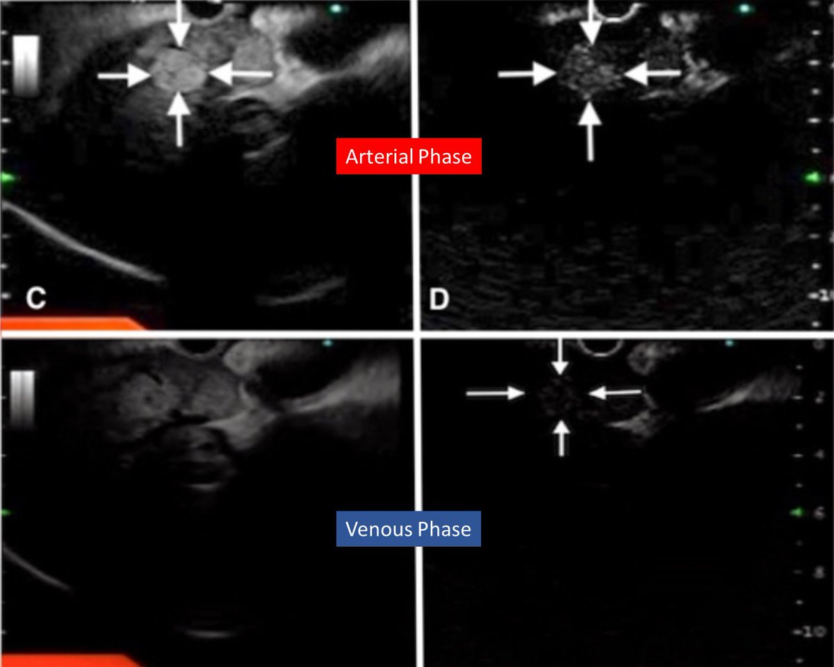 JCEH_Hepatology's tweet photo. Expanding spectrum of Endohepatology!

An interesting case of a hepatocellular carcinoma- missed on CT, picked up on Contrast Enhanced Endoscopic Ultrasound

#LiverTwitter #GITwitter #Endohepatology #RadTwitter
https://t.co/xaVhwiLDfs https://t.co/uZy71a9pmT