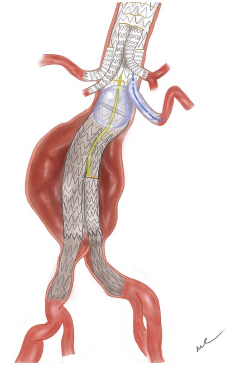 Andrew J. Meltzer, MD, MBA tweet media