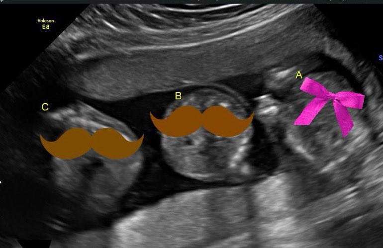 So… me and @GorgeousSavagc have some big news about our child… and it comes in threes. -🩸