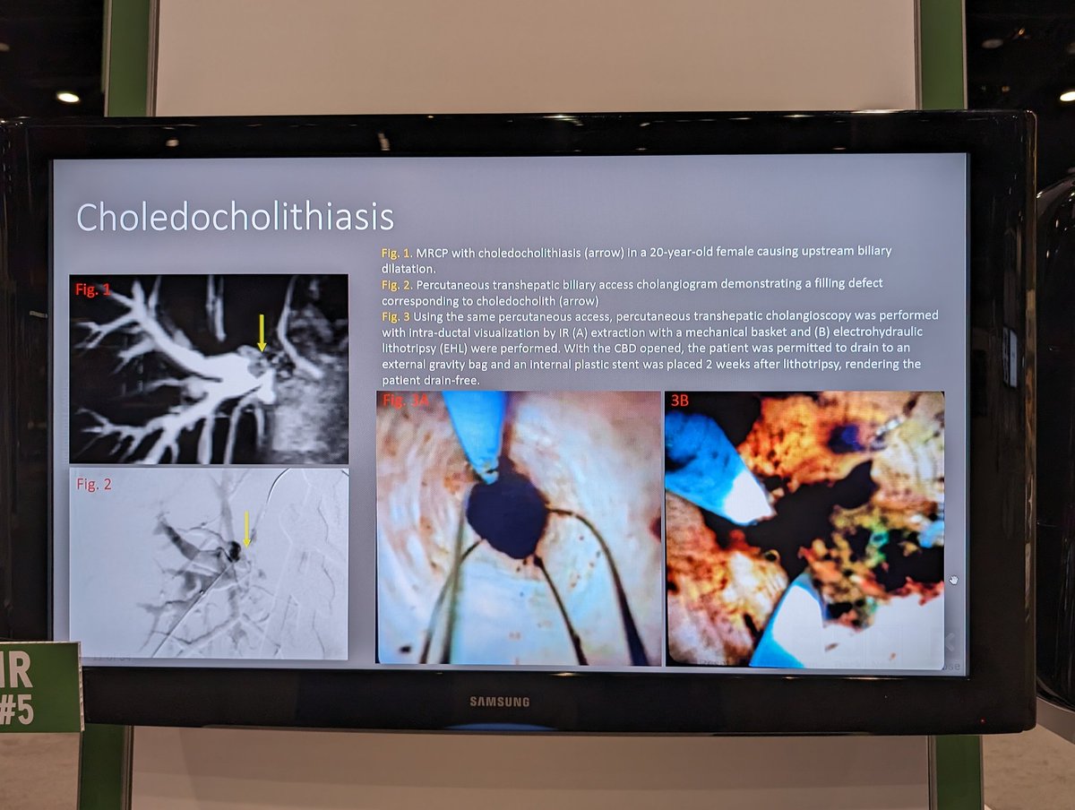 Check out the awesome work and illustration on benign and malignant biliary disease by our stellar #iradres Dan Freedman @NYURadRes @nyuVIR at #RSNA23