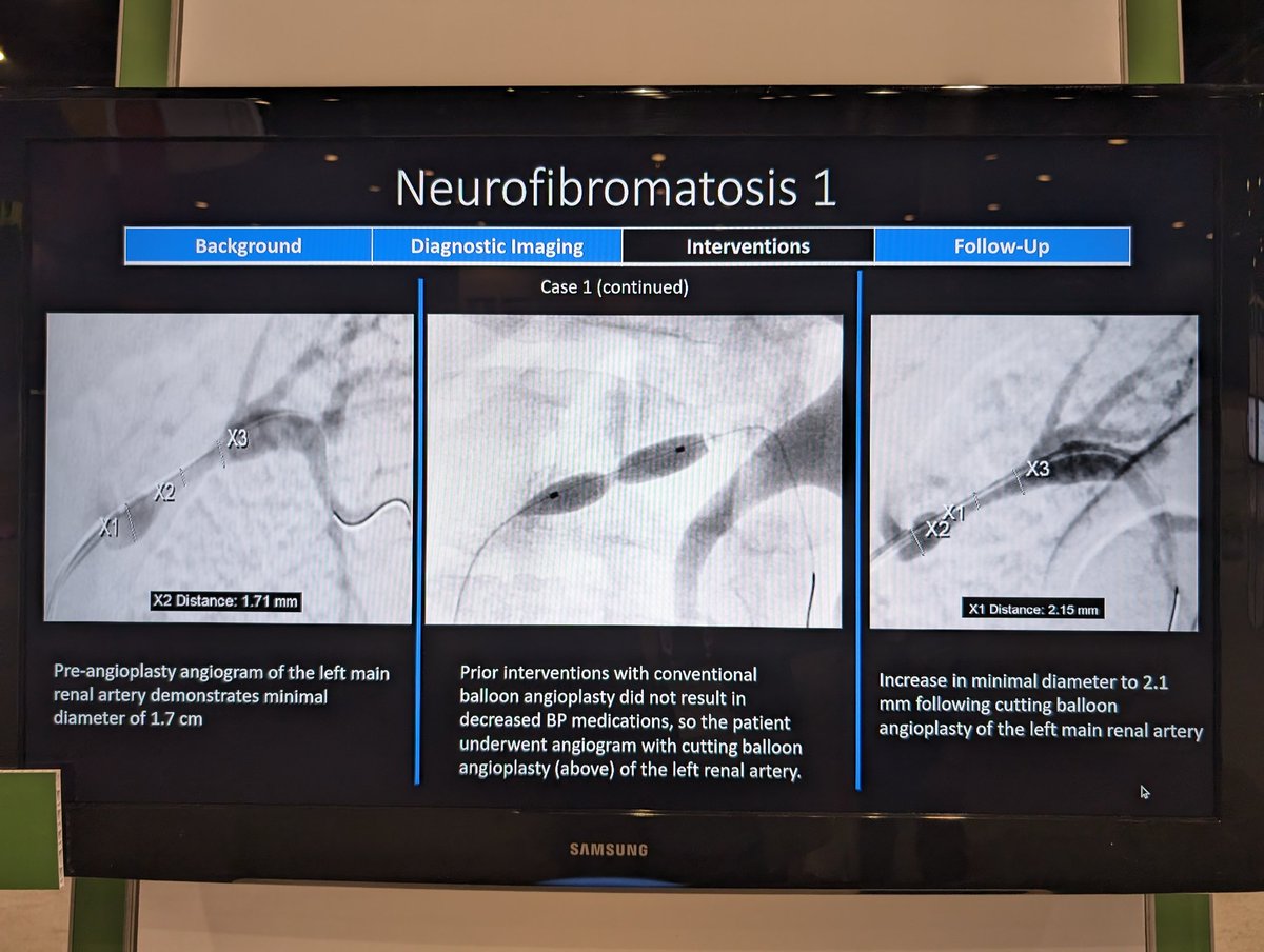 Anthony Chong- our IR-bound #radres @NYURadRes put together this comprehensive review of pediatric renovascular hypertension for #RSNA2023 with our friends at @ChildrensATLRad and @EmoryRadiology! Come by and take a look! @NYUImaging